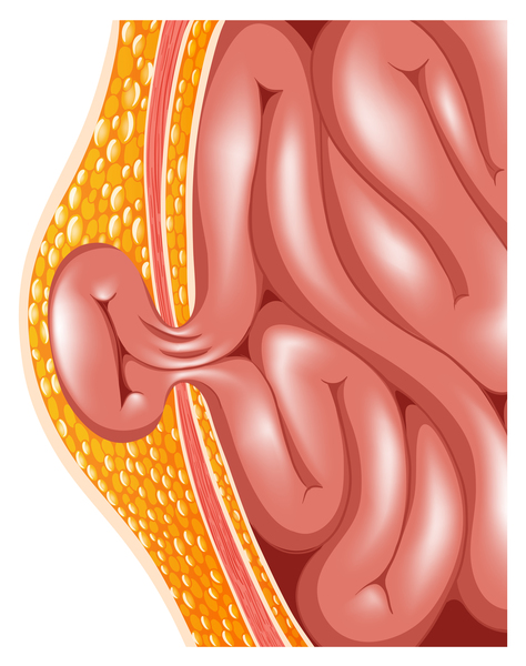 Hérnias.
Hérnia de parede abdominal.
