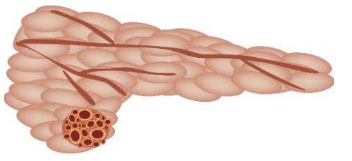 Cistoadenoma seroso