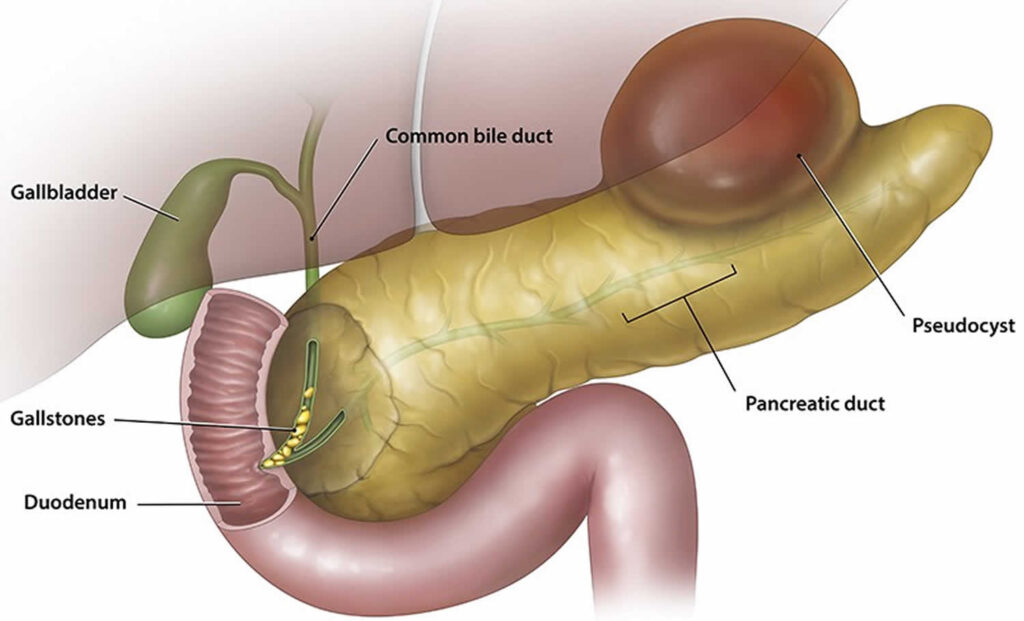 Pseudocisto